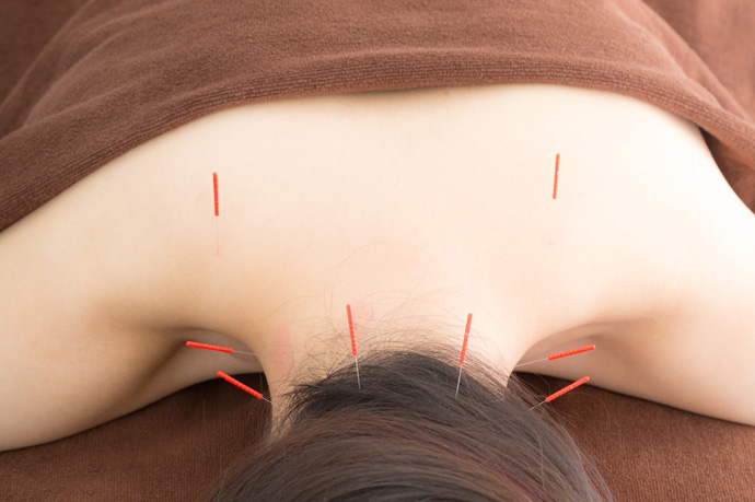 はり灸治療風景